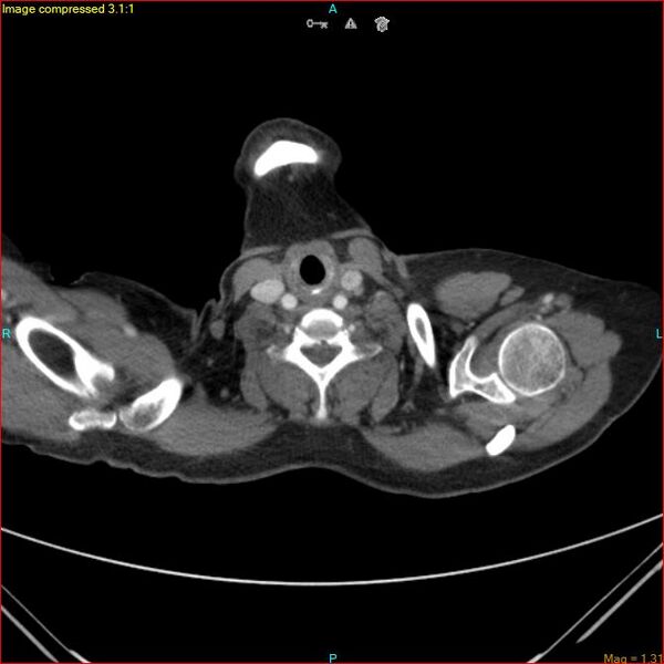 File:Azygos vein aneurysm (Radiopaedia 77824-90130 B 2).jpg