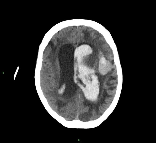 File:Basal ganglia hemorrhage (Radiopaedia 58766-65988 Axial non-contrast 26).jpg
