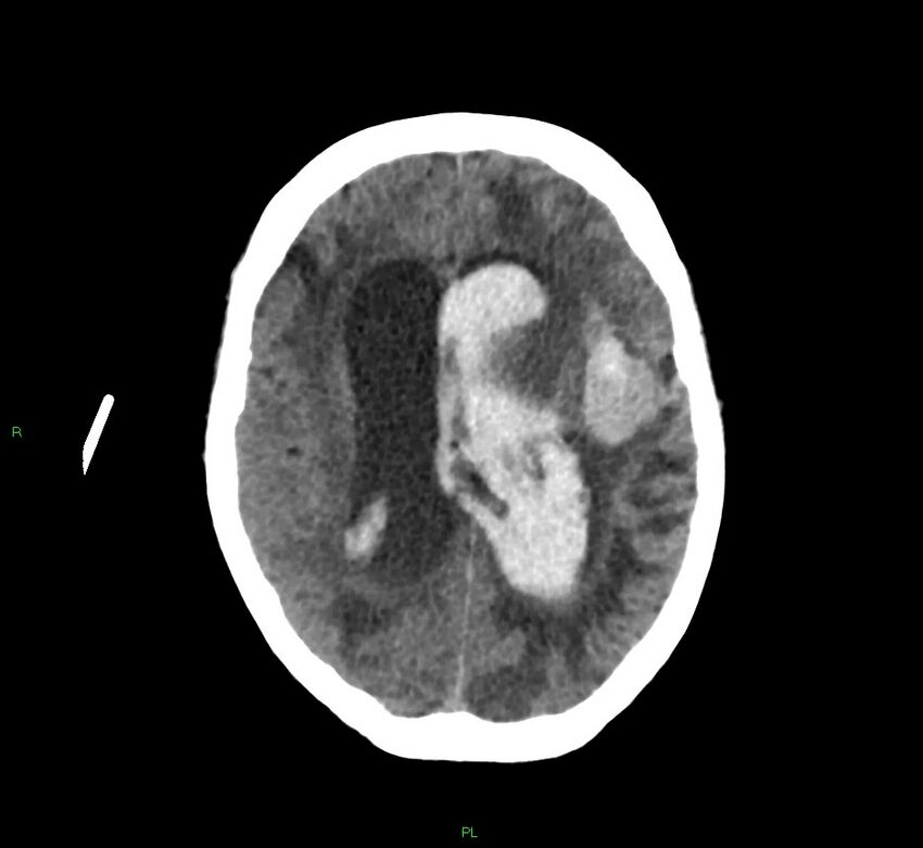 Basal ganglia hemorrhage (Radiopaedia 58766-65988 Axial non-contrast 26).jpg