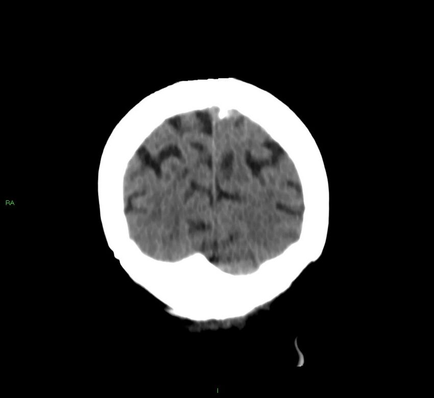 Basal ganglia hemorrhage (Radiopaedia 58790-66024 Coronal non-contrast 9).jpg