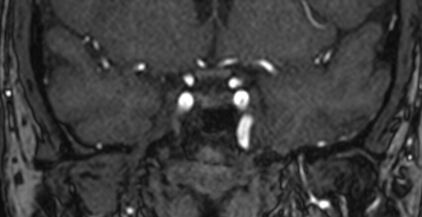 Basilar artery fenestration (Radiopaedia 74537-85455 Coronal MRA TOF 9).jpg