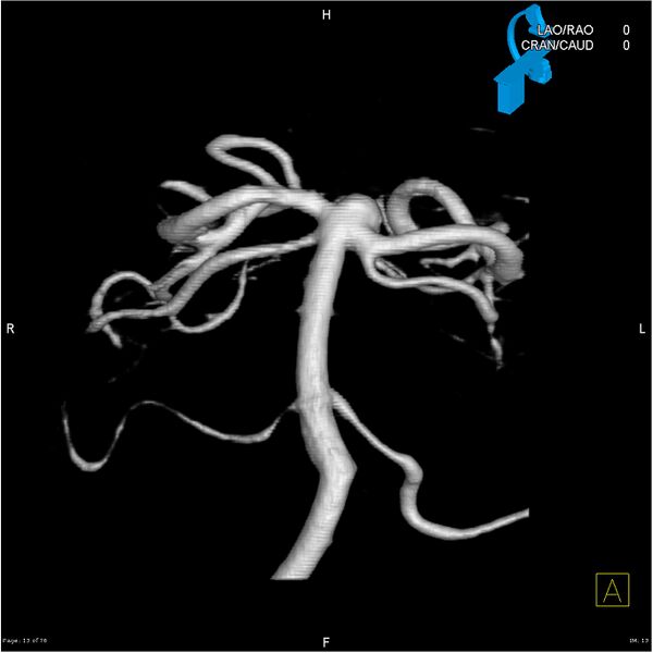 File:Basilar tip aneurysm double balloon remodeling (Radiopaedia 18100-17883 3D rotation 13).jpg