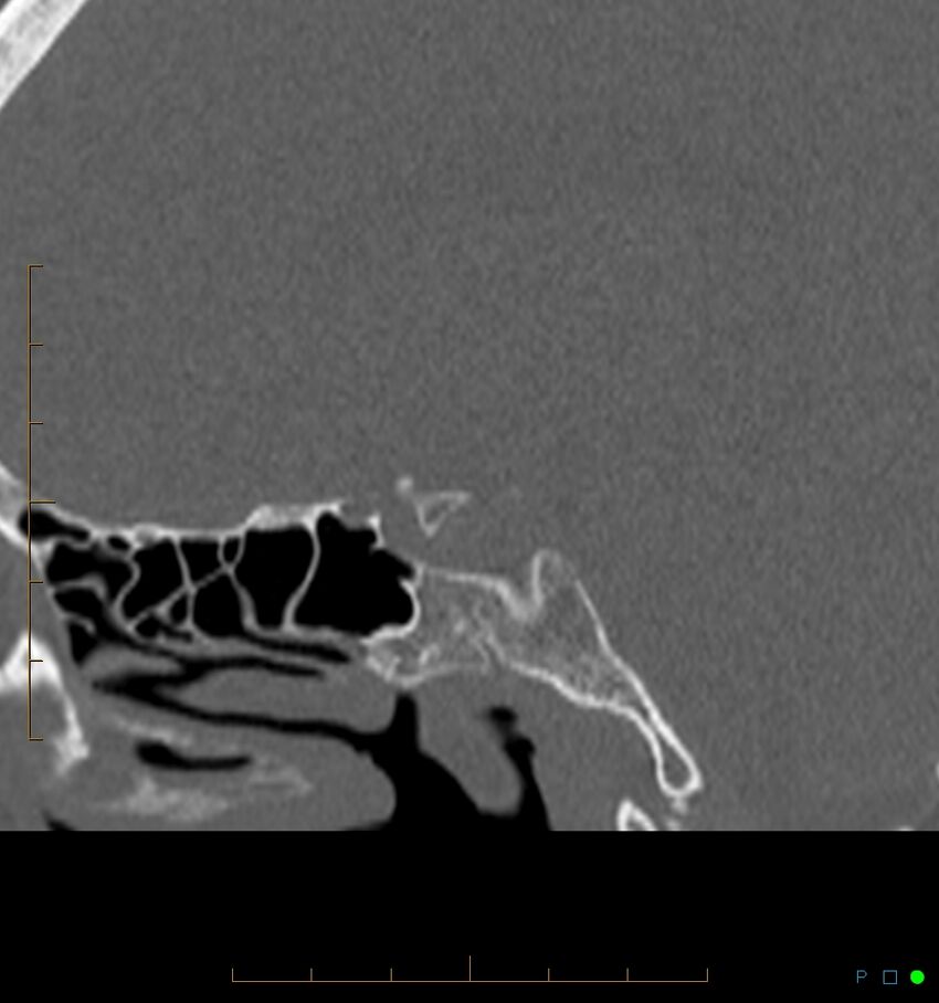 Benign notochordal cell tumor (probable) (Radiopaedia 65475-74546 Sagittal bone window 11).jpg