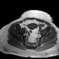 Benign seromucinous cystadenoma of the ovary (Radiopaedia 71065-81300 Axial T1 11).jpg