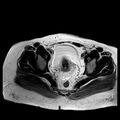 Benign seromucinous cystadenoma of the ovary (Radiopaedia 71065-81300 B 7).jpg