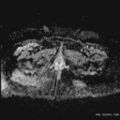 Bicornuate uterus- on MRI (Radiopaedia 49206-54297 Axial ADC 24).jpg