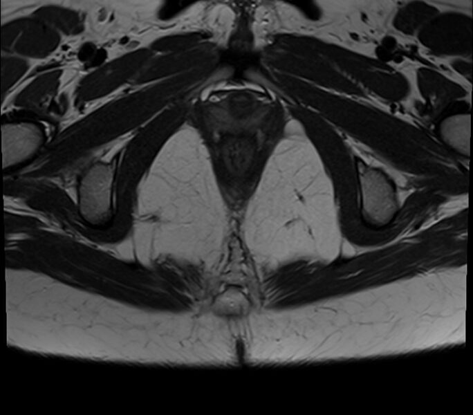 File:Bicornuate uterus (Radiopaedia 71214-81511 Axial T2 4).jpg