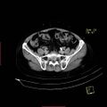 Bifid ureter (Radiopaedia 47604-52253 Axial C+ delayed 20).jpg