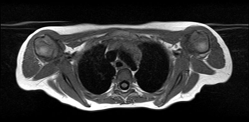 File:Bilateral Sprengel deformity with Klippel-Feil syndrome (Radiopaedia 66395-75650 Axial T1 25).jpg