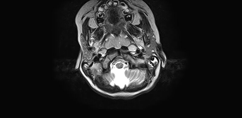 File:Bilateral Sprengel deformity with Klippel-Feil syndrome (Radiopaedia 66395-75650 Axial T2 4).jpg
