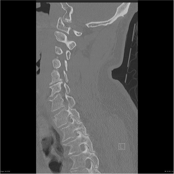 File:Bilateral cervical ribs (Radiopaedia 25868-26017 Sagittal bone window 44).jpg
