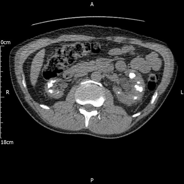 File:Bilateral medullary nephrocalcinosis with ureteric calculi (Radiopaedia 71269-81569 Axial non-contrast 45).jpg