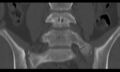 Bilateral pars defect (Radiopaedia 26691-26846 Coronal bone window 21).jpg