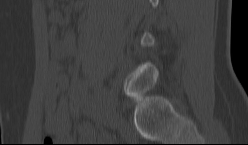Bilateral pars defect (Radiopaedia 26691-26846 Sagittal bone window 46).jpg