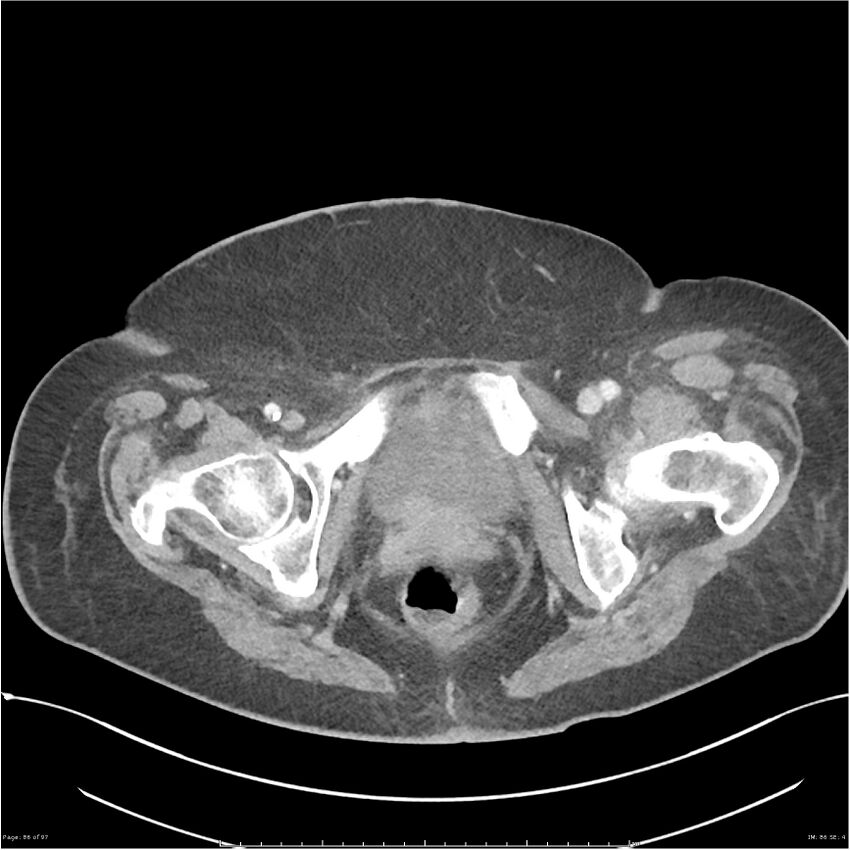 Bilateral psoas hematomas (Radiopaedia 24057-24279 A 86).jpg