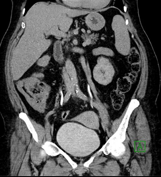 File:Bilateral sporadic synchronous clear cell renal cell carcinoma (Radiopaedia 85035-100575 I 24).jpg