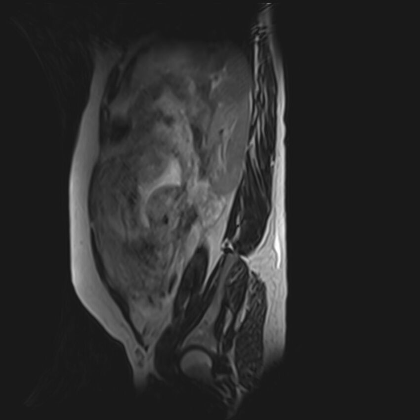 Bilobed placenta accreta (Radiopaedia 69648-79591 G 14).jpg