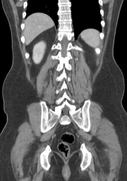 File:Bleeding duodenal ulcer and adenomyomatosis of gallbladder (Radiopaedia 61834-69861 B 19).jpg