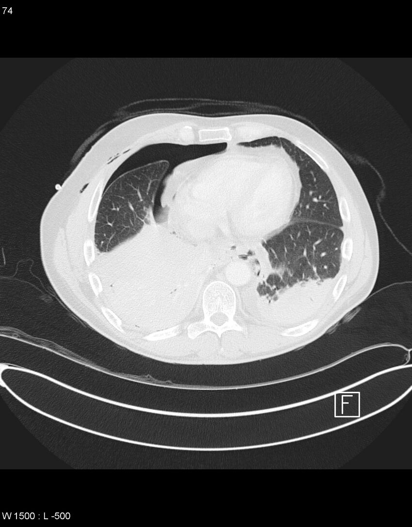 Boerhaave syndrome with tension pneumothorax (Radiopaedia 56794-63605 Axial lung window 36).jpg