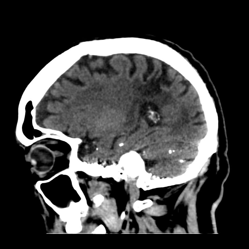 Brain Pantopaque remnants (Radiopaedia 78403-91048 C 18).jpg