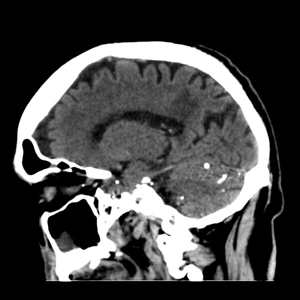 File:Brain Pantopaque remnants (Radiopaedia 78403-91048 C 22).jpg