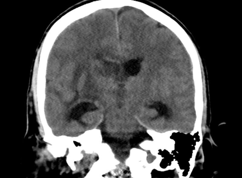 File:Brain abscess complicated by intraventricular rupture and ventriculitis (Radiopaedia 82434-96575 Coronal non-contrast 13).jpg