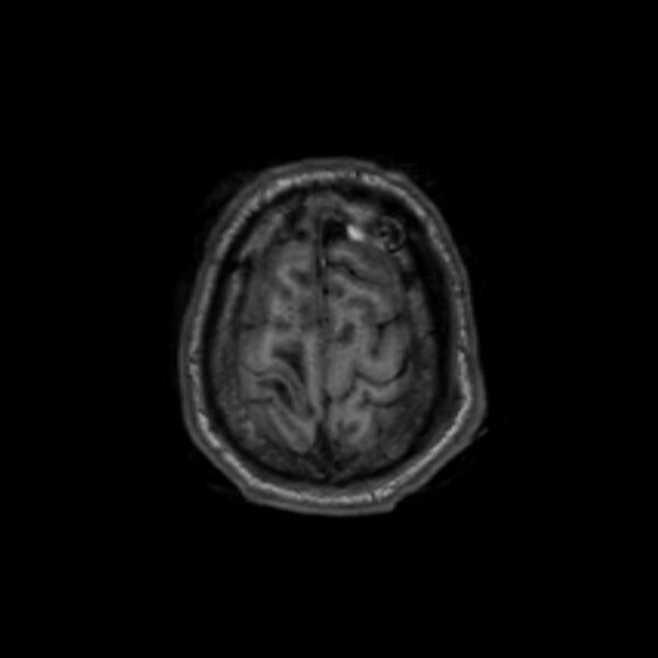 File:Brain abscess complicated by intraventricular rupture and ventriculitis (Radiopaedia 82434-96577 Axial T1 64).jpg
