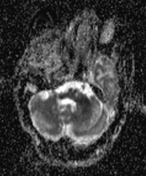 File:Brain abscess with dual rim sign (Radiopaedia 87566-103938 Axial ADC 3).jpg