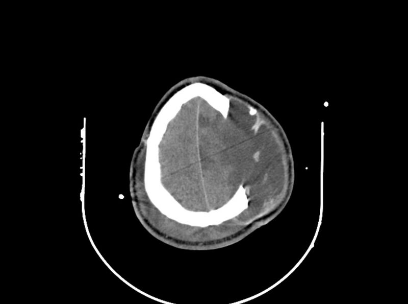 File:Brain injury by firearm projectile (Radiopaedia 82068-96087 B 157).jpg