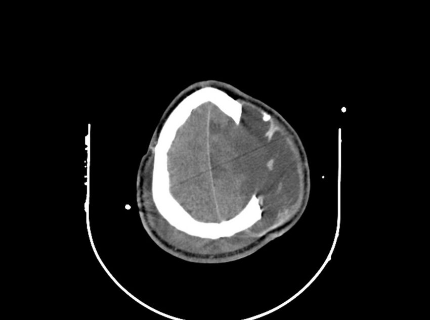 Brain injury by firearm projectile (Radiopaedia 82068-96087 B 157).jpg