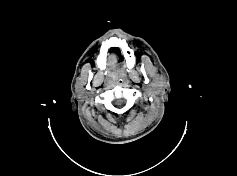 File:Brain injury by firearm projectile (Radiopaedia 82068-96087 B 30).jpg
