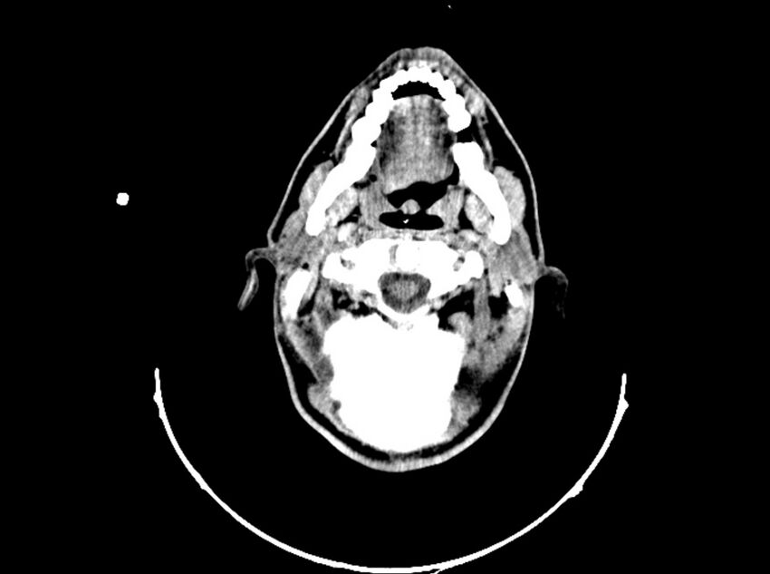 Brain injury by firearm projectile (Radiopaedia 82068-96088 A 55).jpg