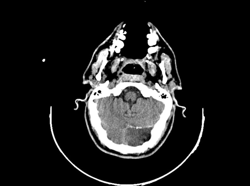 Brain injury by firearm projectile (Radiopaedia 82068-96088 A 72).jpg