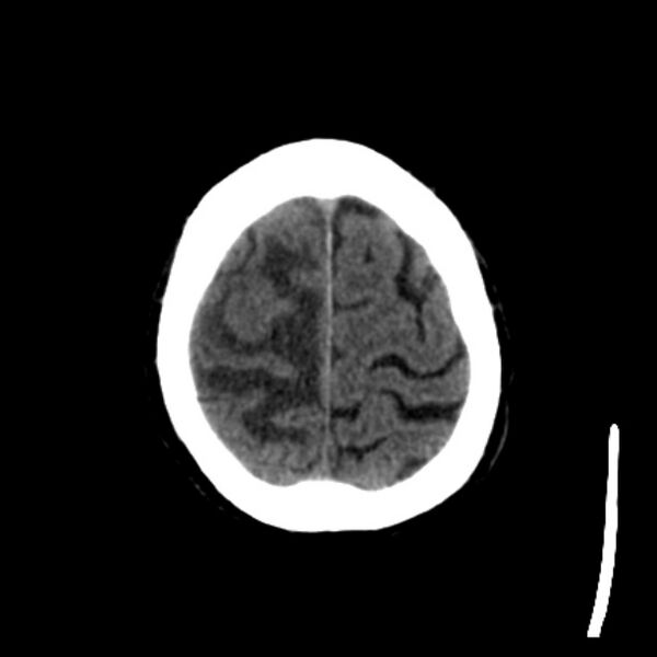 File:Brain metastases from lung cancer (Radiopaedia 27849-28092 Axial non-contrast 40).jpg