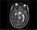 Brainstem glioma (Radiopaedia 21819-21775 Axial T2 16).jpg