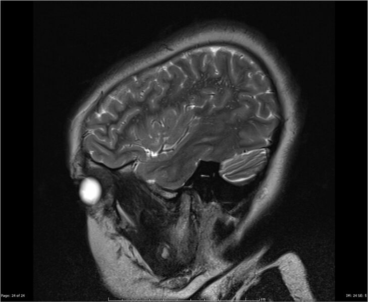 File:Brainstem glioma (Radiopaedia 21819-21775 Sagittal T2 24).jpg