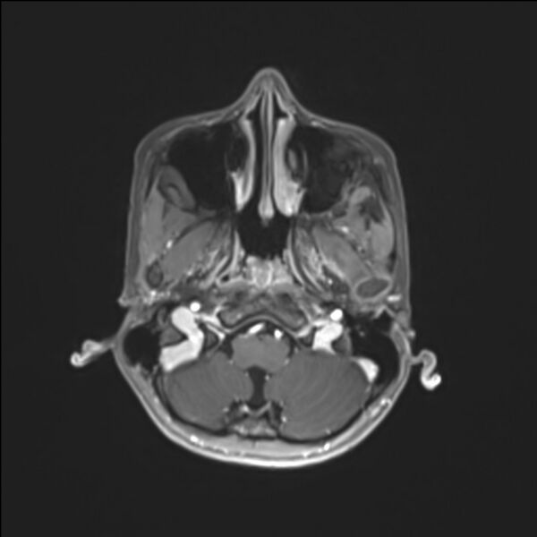 File:Brainstem glioma (Radiopaedia 70548-80674 Axial T1 C+ 28).jpg