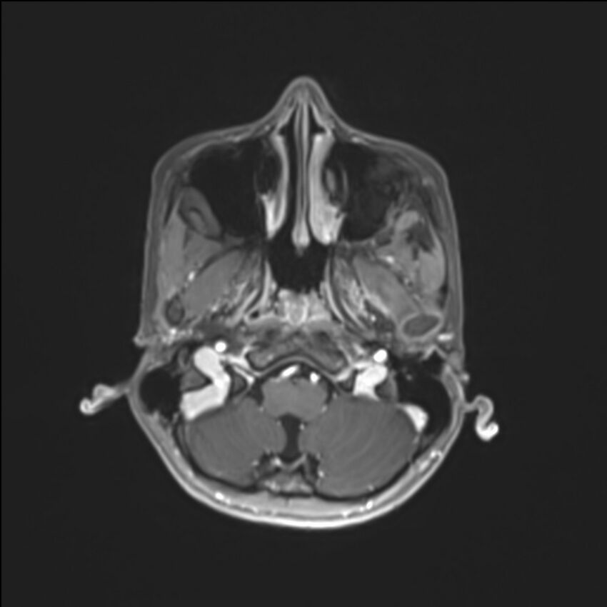 Brainstem glioma (Radiopaedia 70548-80674 Axial T1 C+ 28).jpg