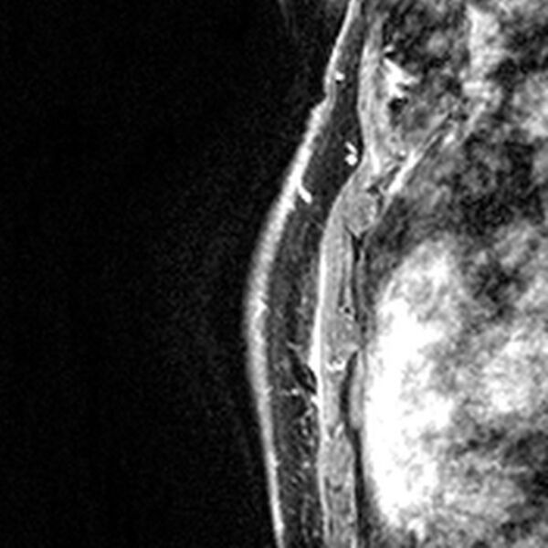 File:Breast implants - MRI (Radiopaedia 26864-27035 Sagittal T2 50).jpg