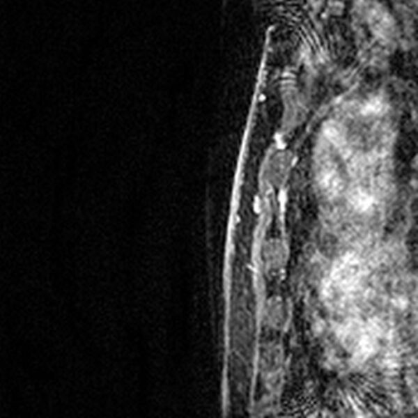 File:Breast implants - MRI (Radiopaedia 26864-27035 Sagittal T2 72).jpg
