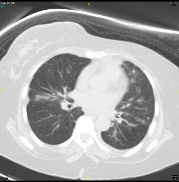 File:Breast primary with lung and bone metastases (Radiopaedia 40620-43228 Axial lung window 27).jpg