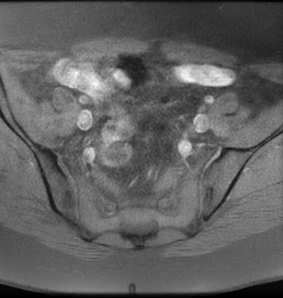 File:Broad ligament leiomyoma (Radiopaedia 81634-95516 Axial T1 fat sat 6).jpg