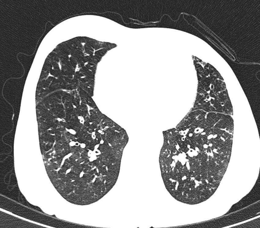 Bronchiolitis (Radiopaedia 24616-24887 Axial lung window 41).jpg
