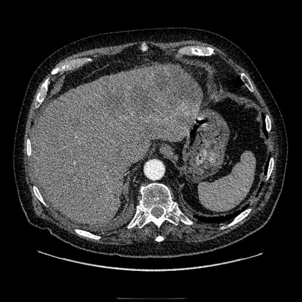 File:Bronchogenic adenocarcinoma and pulmonary embolism (Radiopaedia 9097-9806 D 52).jpg