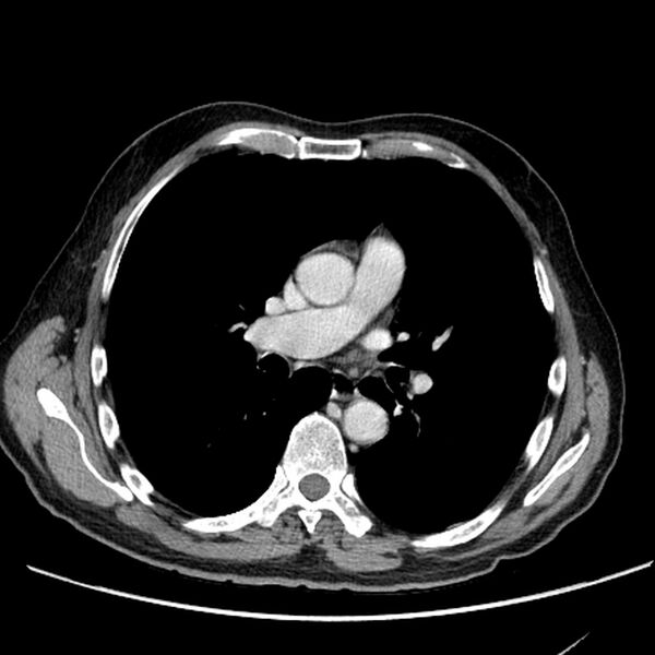 File:Bronchogenic carcinoma with L1 vertebra metastasis (Radiopaedia 9096-9805 Axial C+ delayed 16).jpg