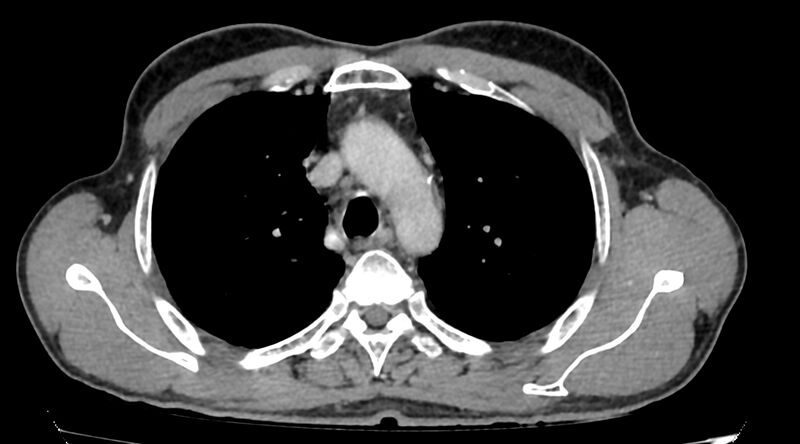 File:Bronchogenic carcinoma with superior vena cava syndrome (Radiopaedia 36497-38054 Axial C+ delayed 26).jpg