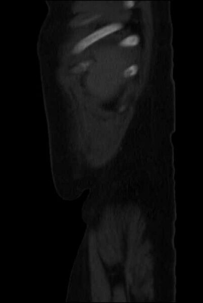File:Brown tumors compressing the spinal cord (Radiopaedia 68442-77988 H 53).jpg
