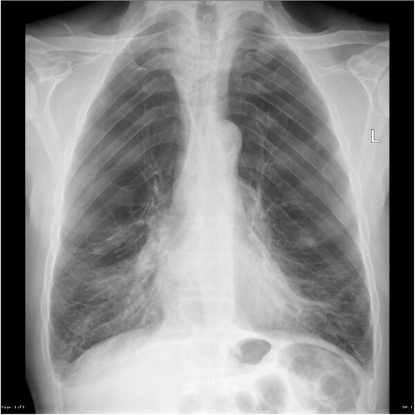 File:Bullous emphysema (Radiopaedia 15354-15155 Frontal 1).jpg
