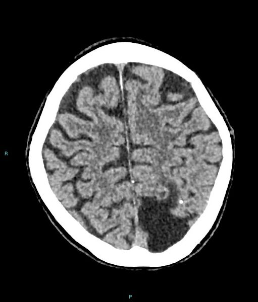File:Calcified cerebral emboli from left ventricular thrombus (Radiopaedia 84420-99758 Axial non-contrast 25).jpg