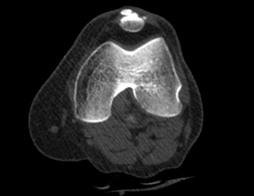 Calcified hematoma - popliteal fossa (Radiopaedia 63938-72763 Axial bone window 4).jpg